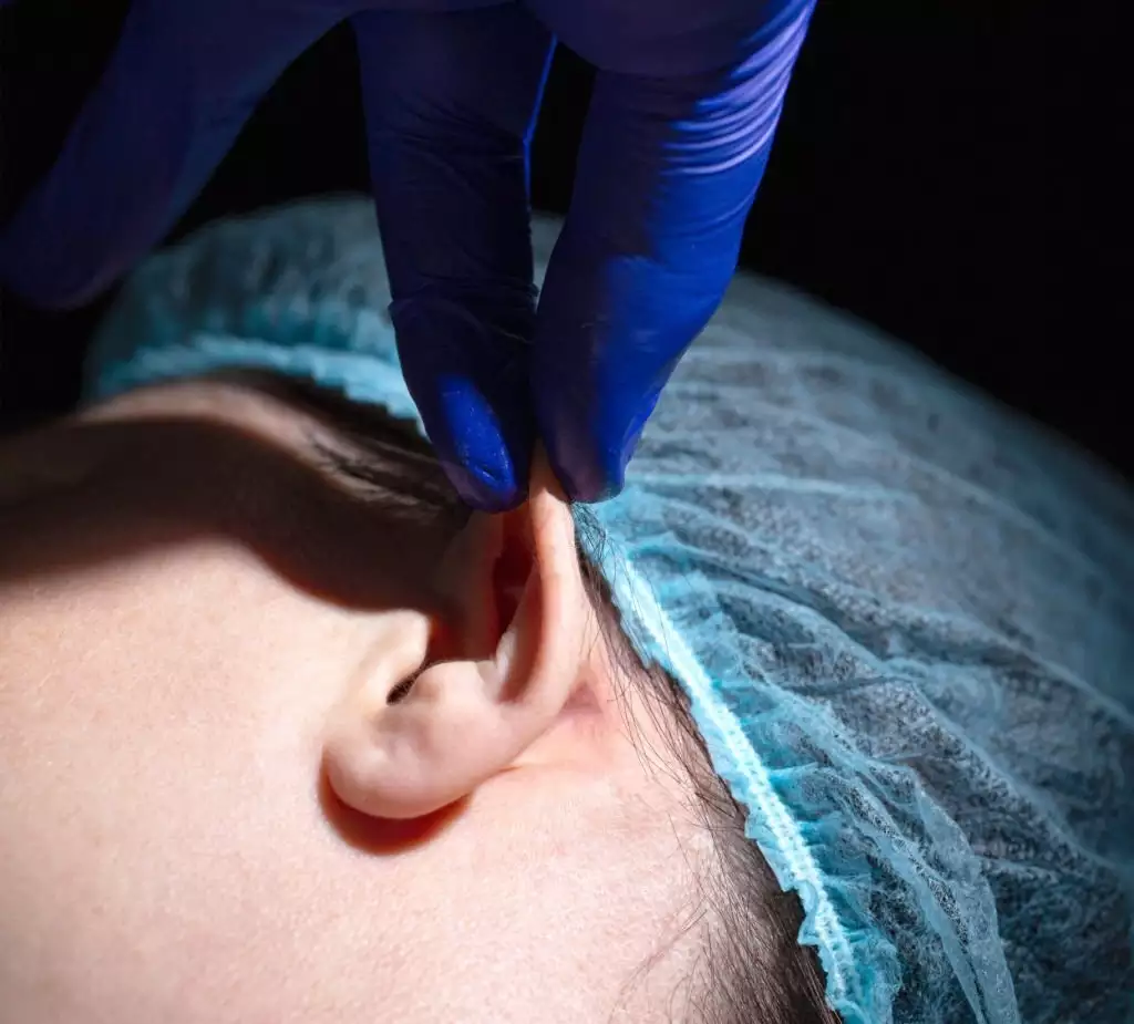 La Chirurgia Dell'orecchio Prominente È Permanente?