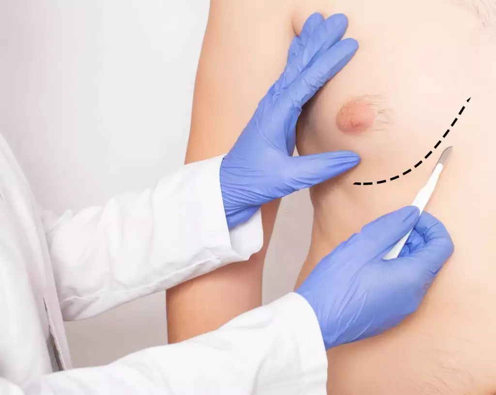 Quels ont les avantages de la chirurgie de réduction mammaire ?