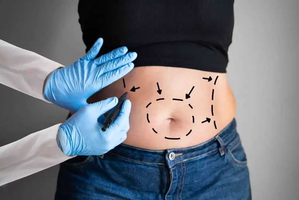 Who Is Suitable For Abdominoplasty?