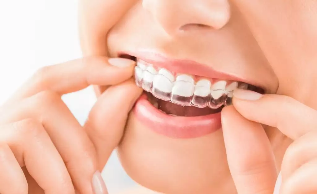 Zahnspangenbehandlung (Kieferorthopädie)