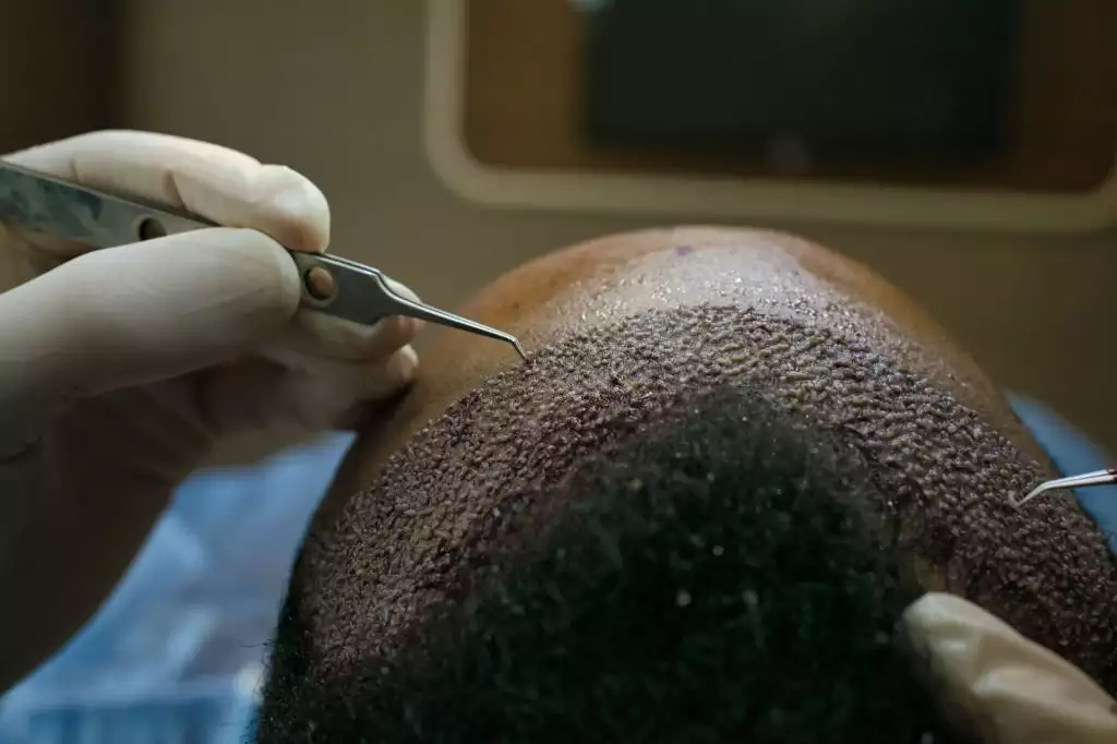 How much are the hair transplant prices in Istanbul?