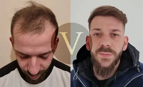 saç ekimi öncesi ve sonrası